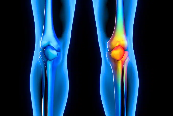 Understanding Arthritis